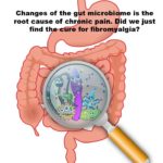 Fibromyalgia is caused by a gut imbalance